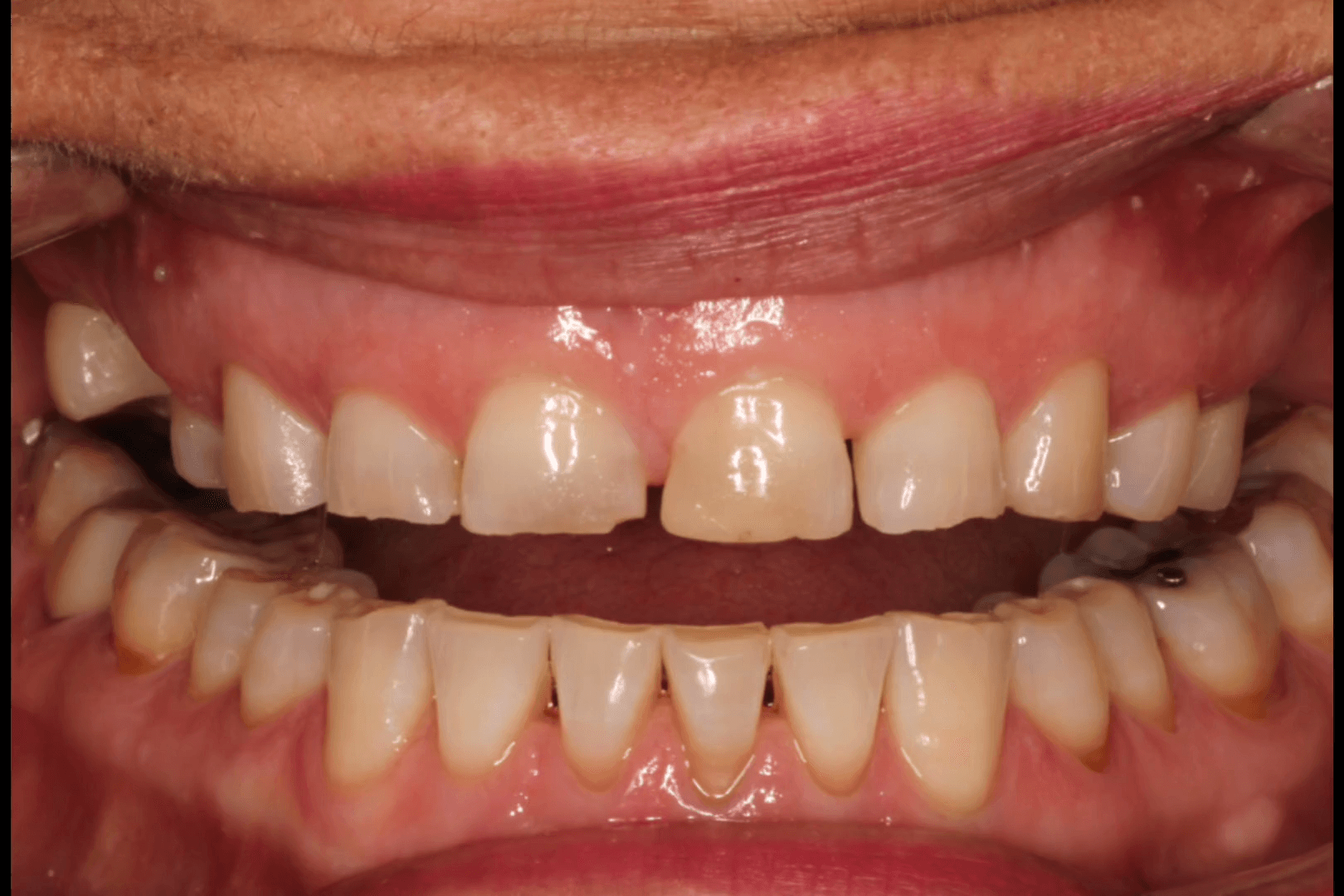 Before and after smile transformation, example one