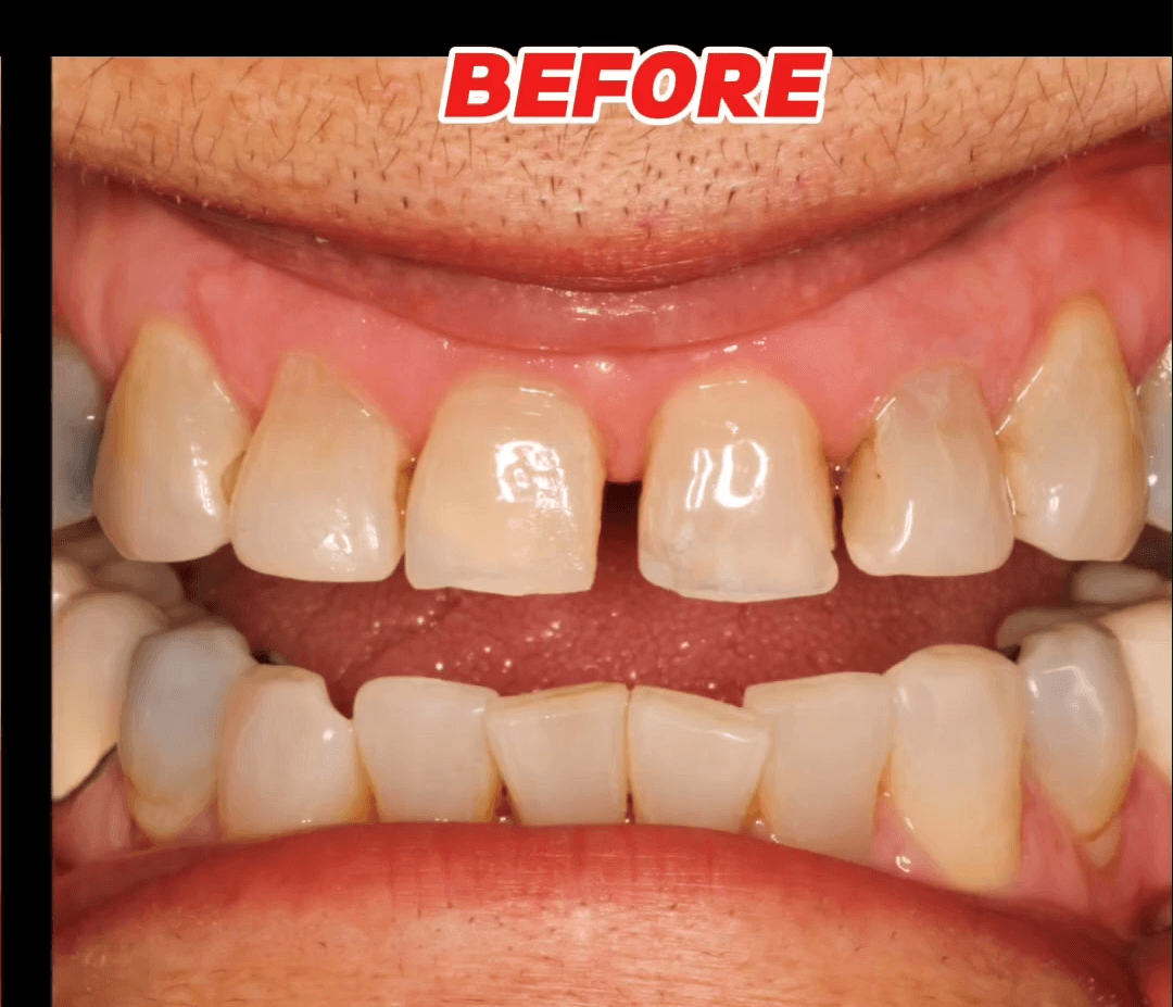 Before and after smile transformation, example two
